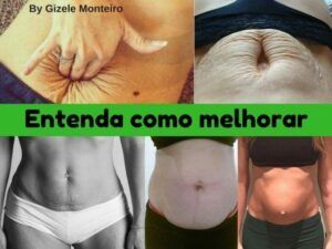 Flacidez Da Barriga Depois Da Gravidez Gizele Monteiro