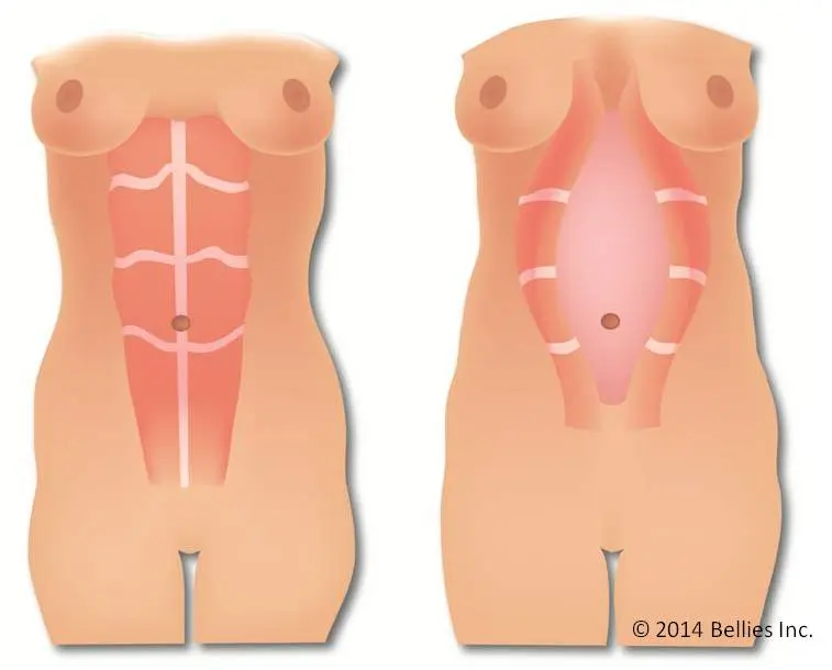 abdominal vacuum para diástase