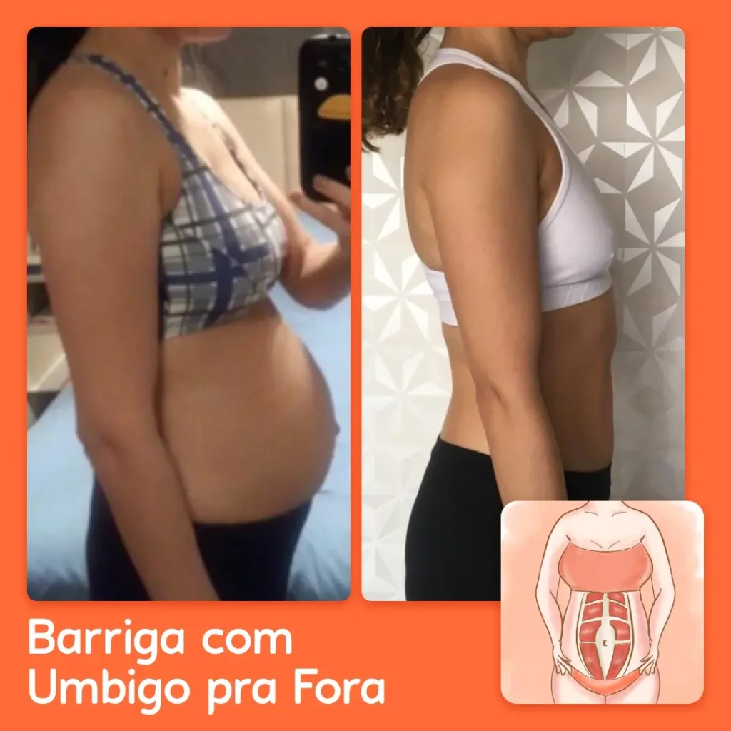 acabar com diástase e flacidez abdominal