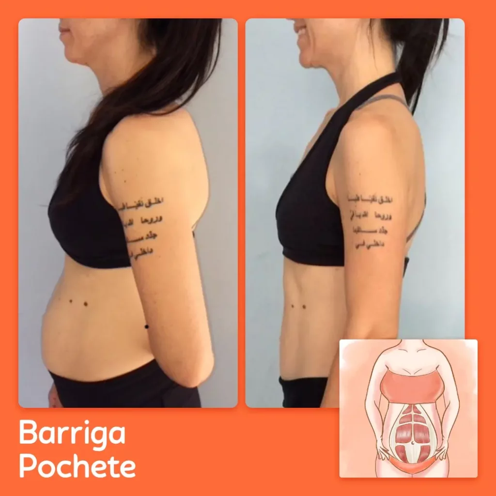 barriga pochete