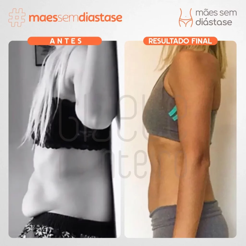 diástase abdominal depois da gravidez