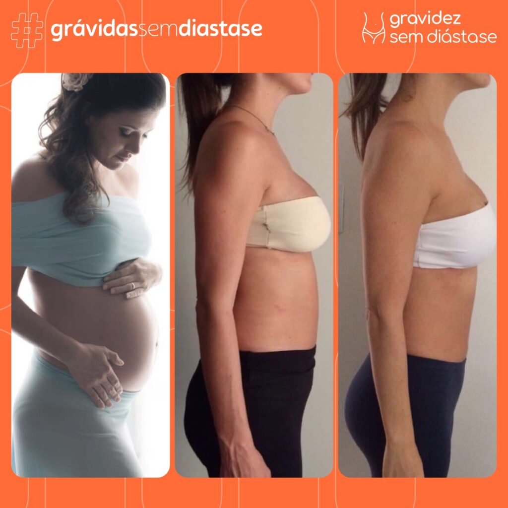 Gizele Monteiro Especialista Em Diástase E Flacidez Abdominal 