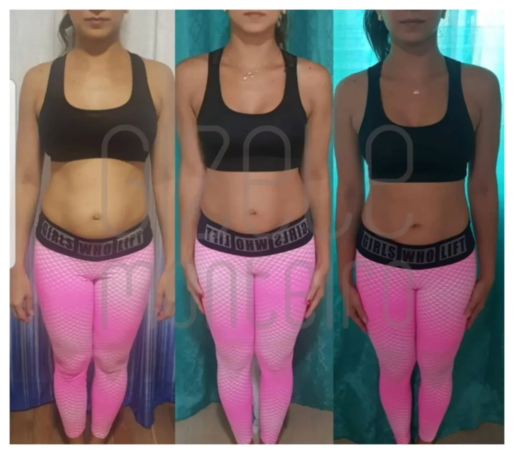 eliminar a diástase sem cirurgia