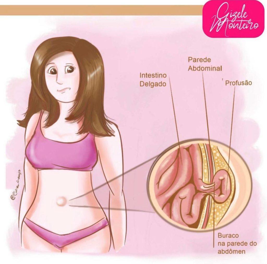 Hérnia e Diástase sempre juntinhas
