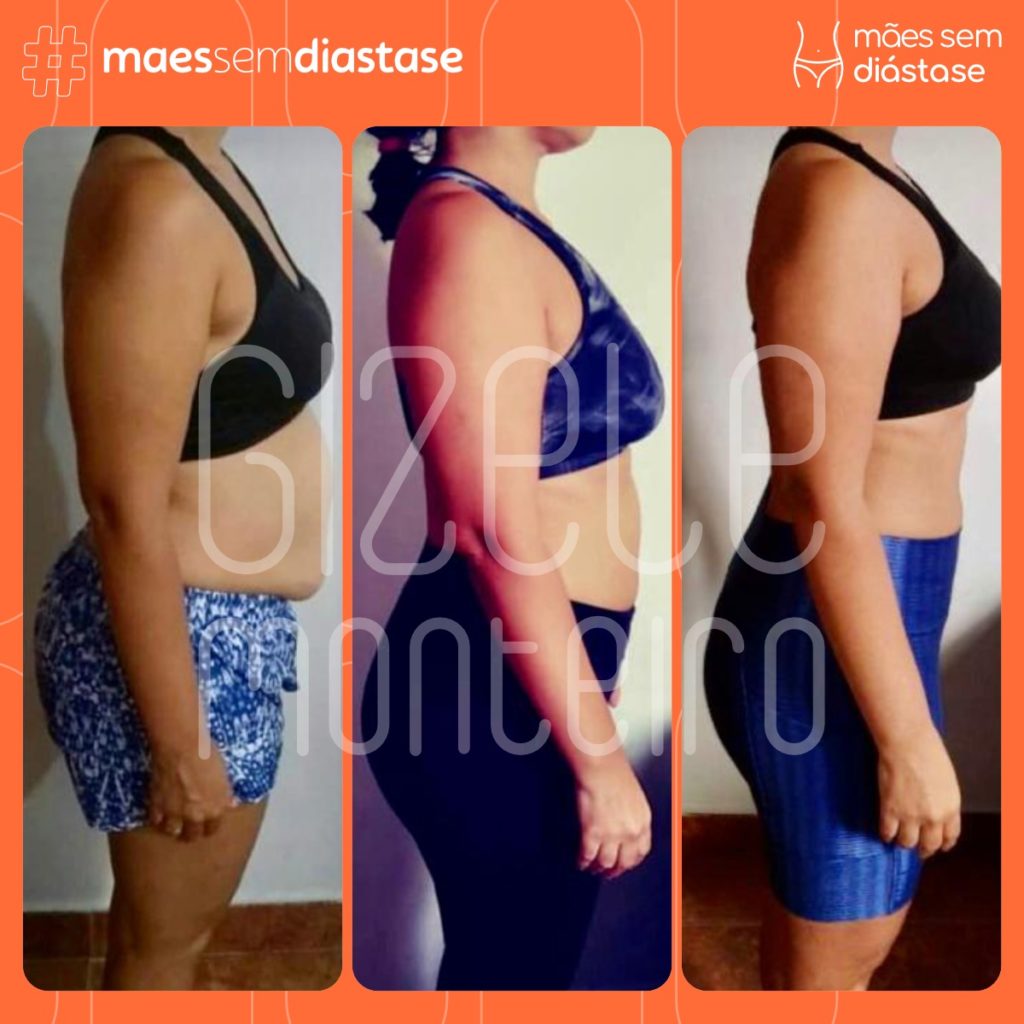 como tratar a diastase Gizele Monteiro