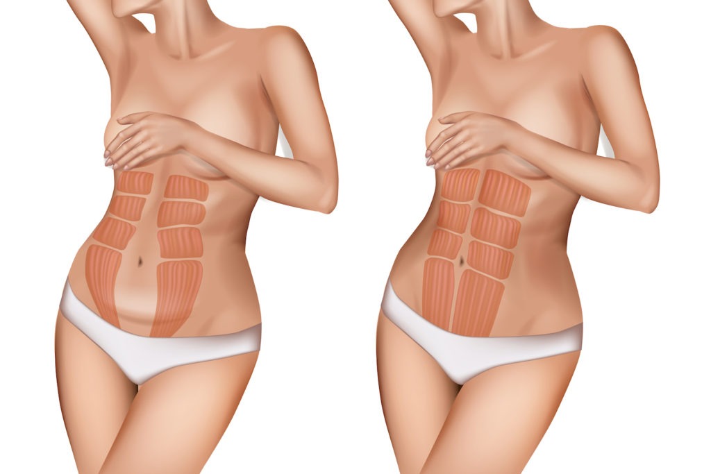 afastamento dos músculos retos abdominais