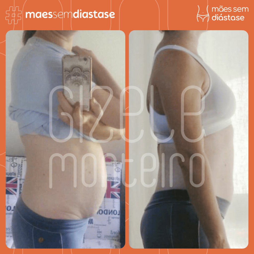 Diástase abdominal pós parto O que fazer Gizele Monteiro