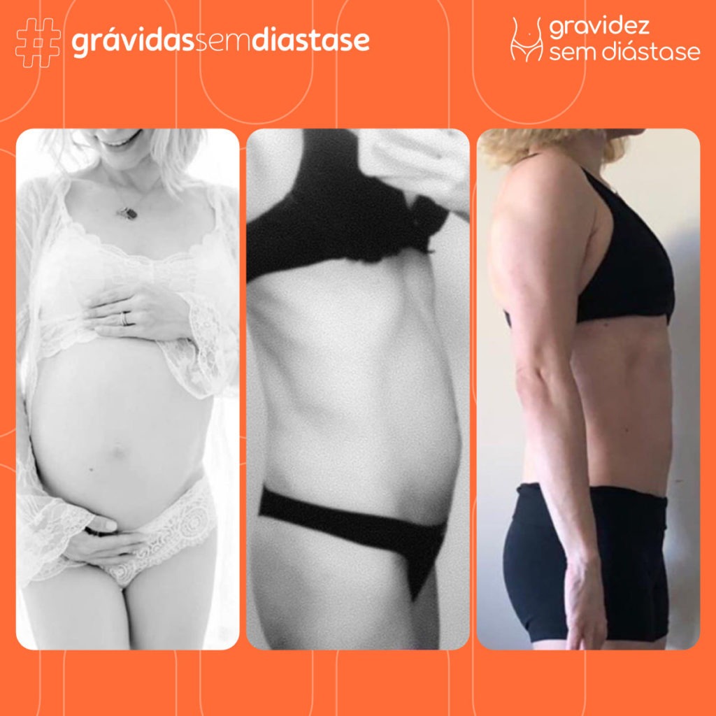 gravidez sem diástase