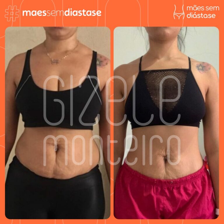 barriga flácida recuperada