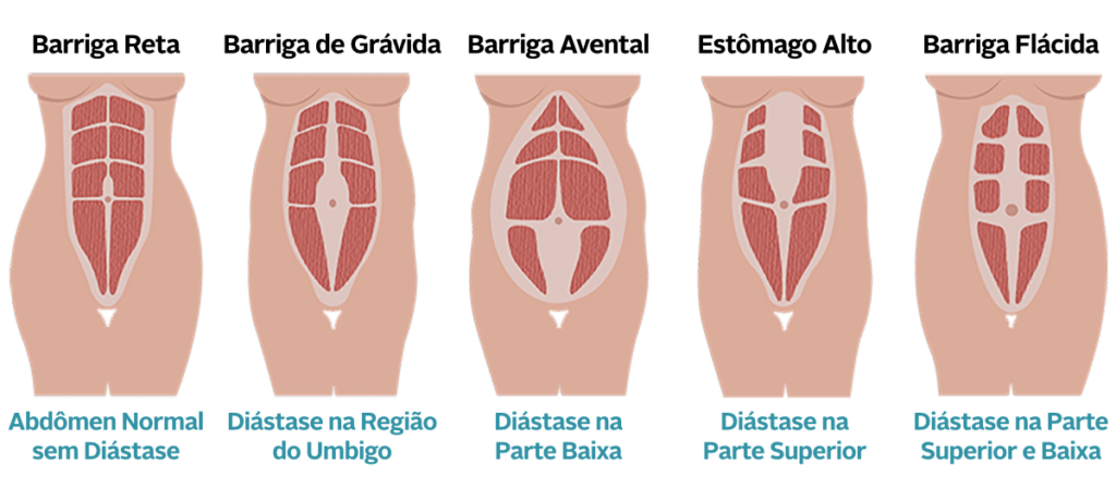 tratamento da diástase abdominal