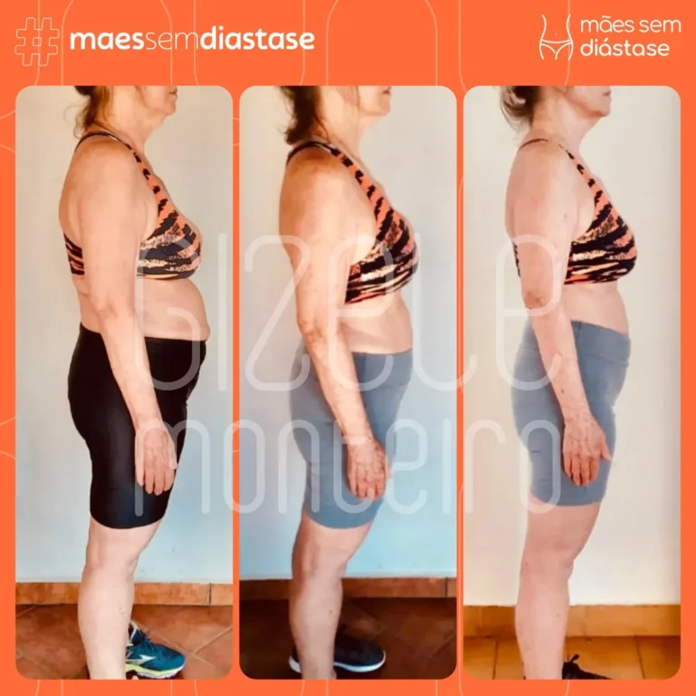 recuperar a barriga depois de anos da gravidez