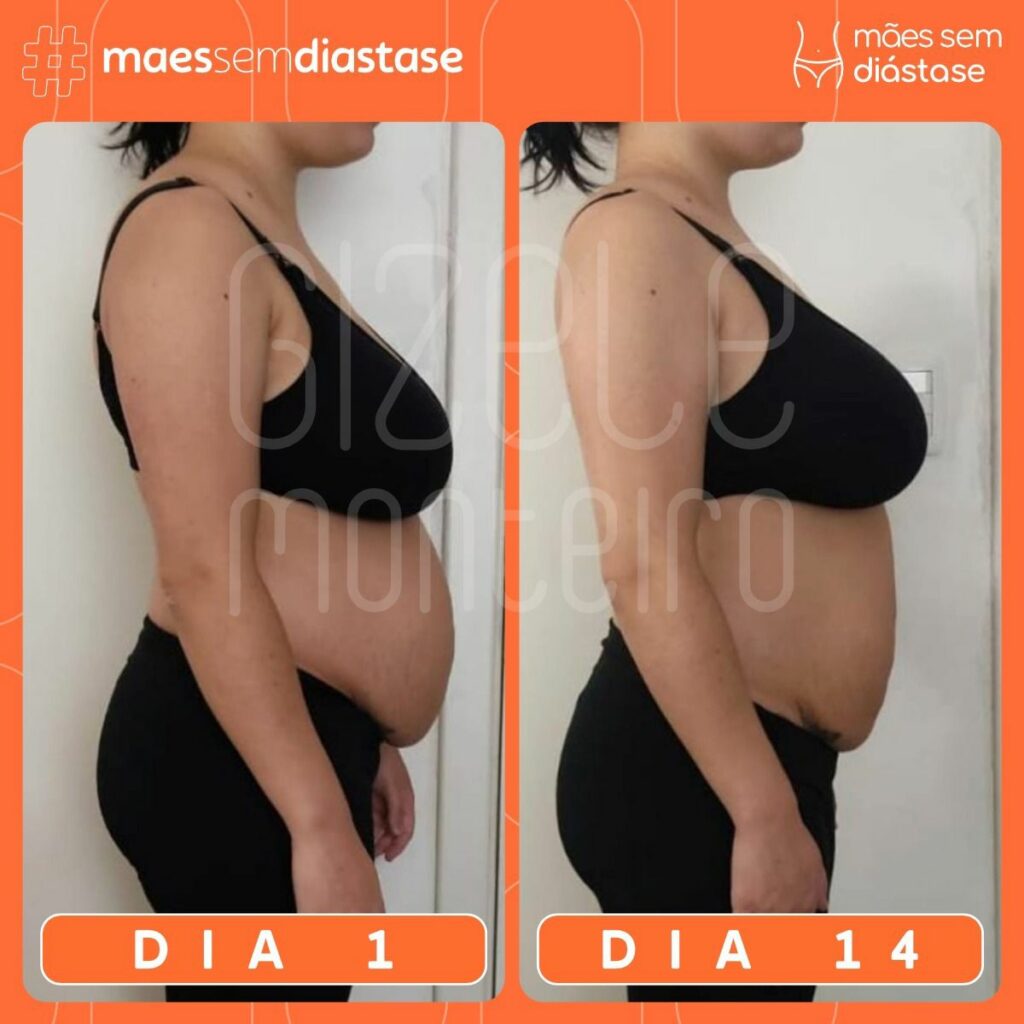 Como Está A Sua Barriga Depois Do Parto Gizele Monteiro Mães Sem Diástase 