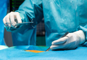 Cirurgia de diástase
