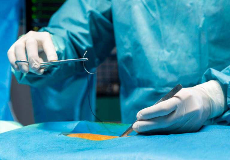 Cirurgia de diástase