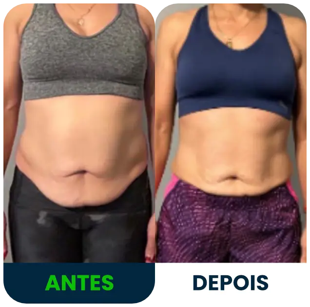 Antes e depois da diástase abdominal — resultado real