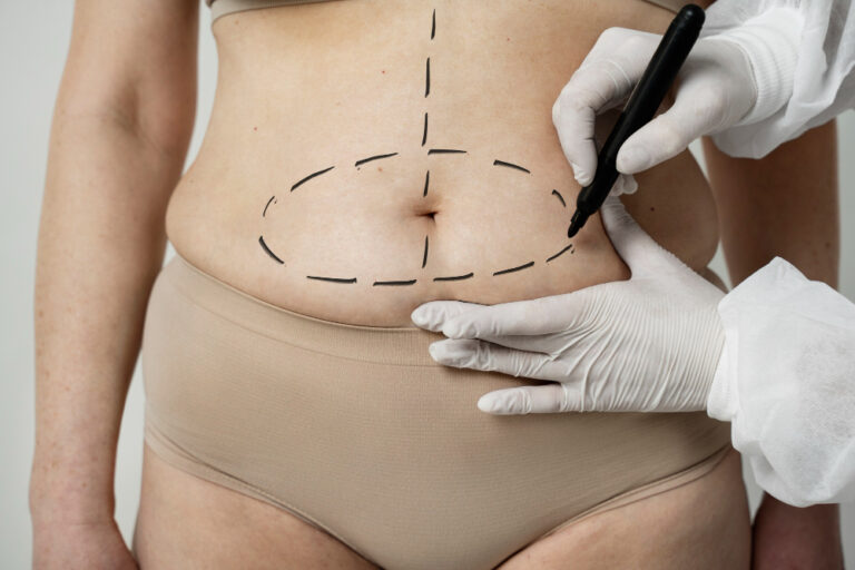 cirurgia para a barriga após a gravidez
