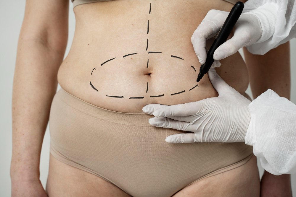 cirurgia para a barriga após a gravidez