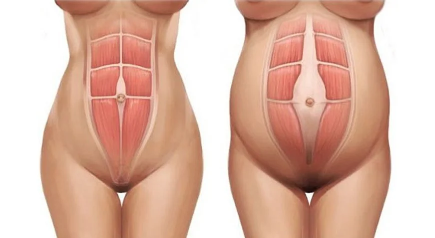 diástase abdominal e flacidez