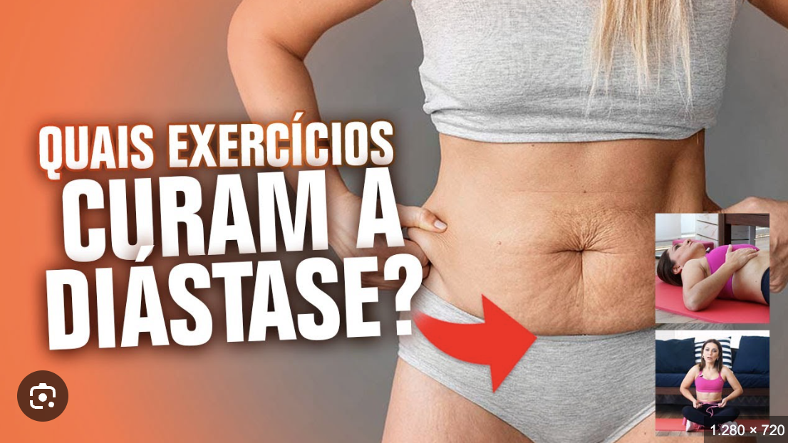 como tratar diastase com exercicios