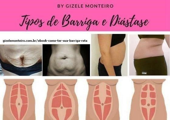 Tipos de barriga e Diástase - Programa Pós-parto em Forma Gizele Monteiro