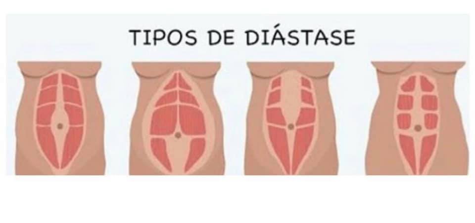 barriga depois da gravidez